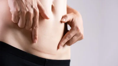 Aceite Esencial de Rosa Mosqueta para Cicatrices y Estrías